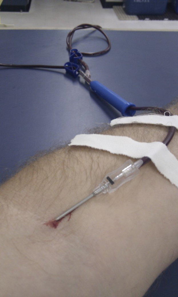 Eine Person Hand mit einer Kochsalzröhre und Nadel sowie mehreren Pflastern auf der Haut.